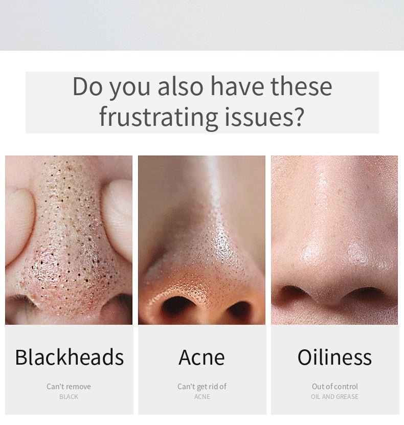 Mysa Day Spa - Blackhead Vacuum Device - Mysa Day Spa