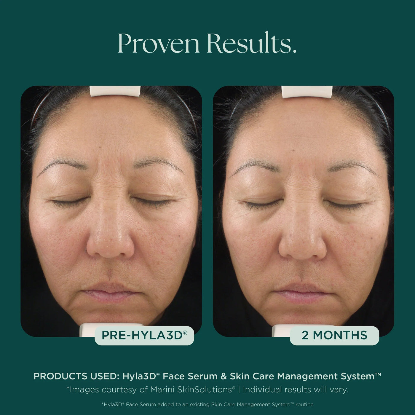 Marini Hyla3D® Face Serum Hyaluronic Acid Complex - Premium Jan Marini Skin Research from Mysa Day Spa - Just $125! Shop now at Mysa Day Spa