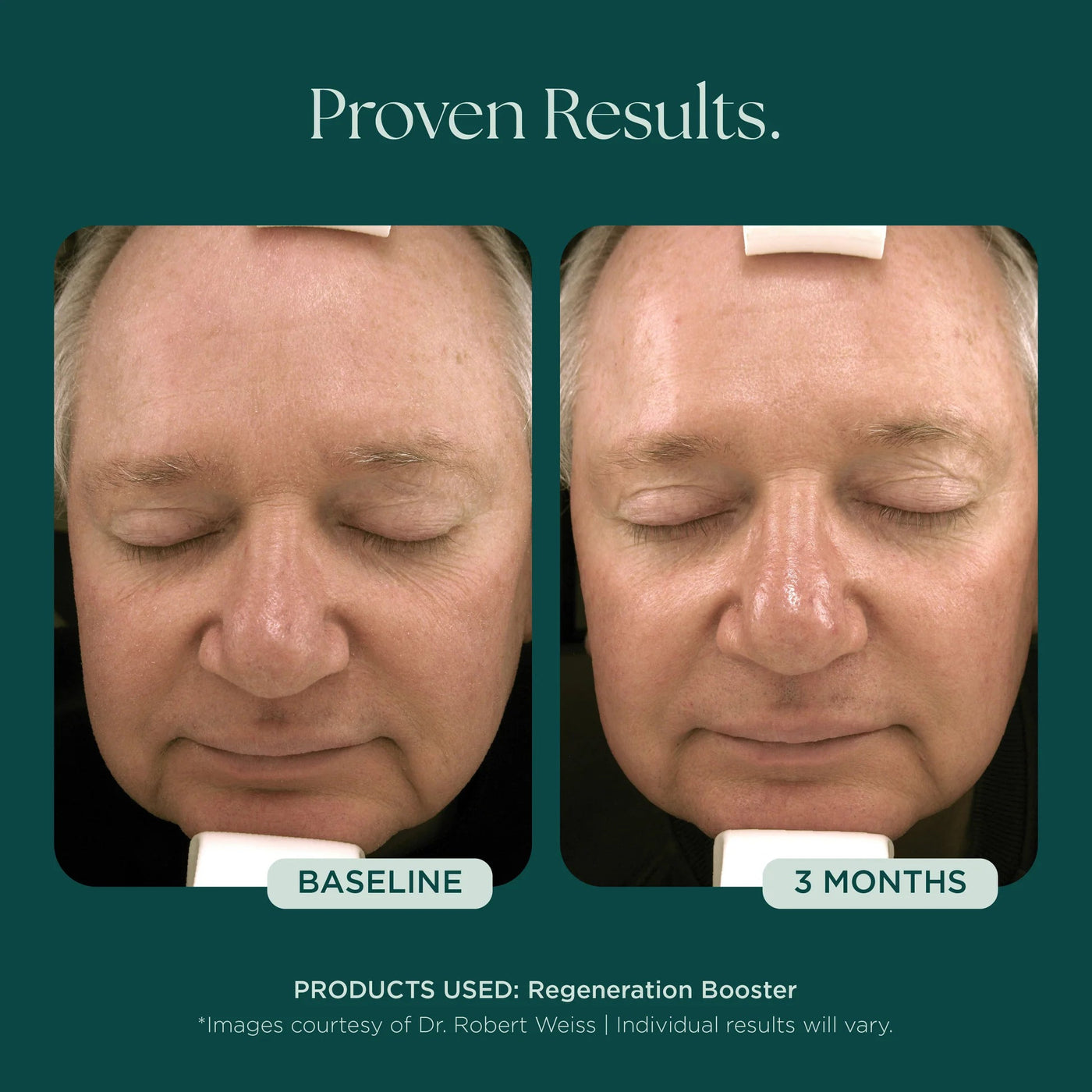 Marini Regeneration Booster - Premium  from Mysa Day Spa - Just $248! Shop now at Mysa Day Spa