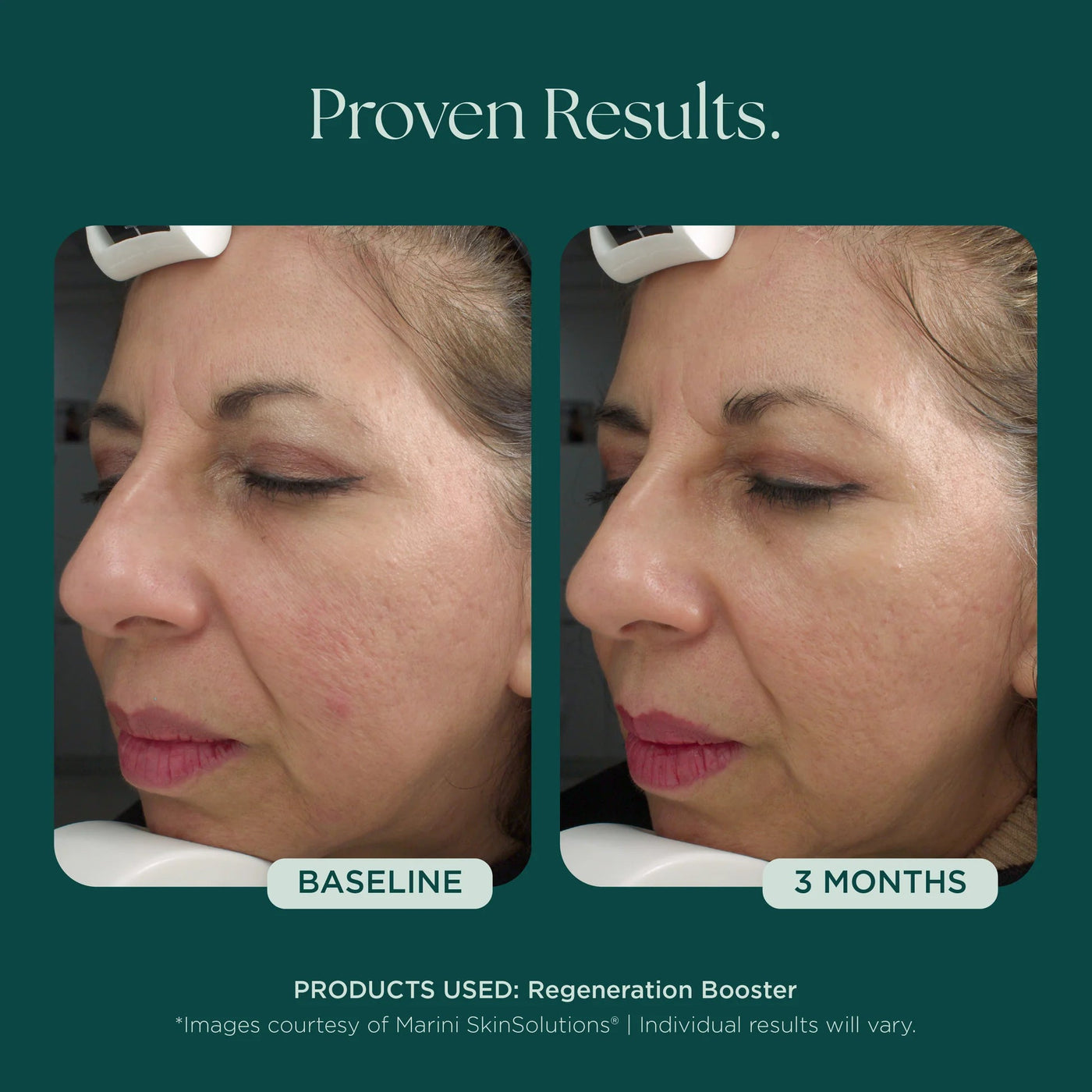 Marini Regeneration Booster - Premium  from Mysa Day Spa - Just $248! Shop now at Mysa Day Spa