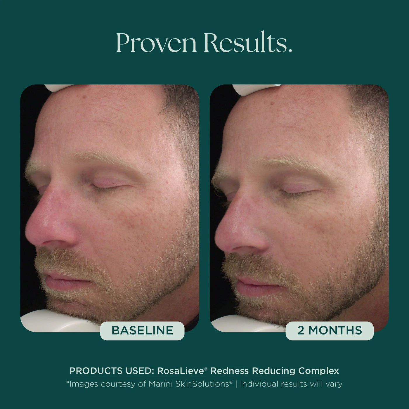 Marini RosaLieve® Redness Reducing Complex - Premium Jan Marini Skin Research from Mysa Day Spa - Just $112! Shop now at Mysa Day Spa