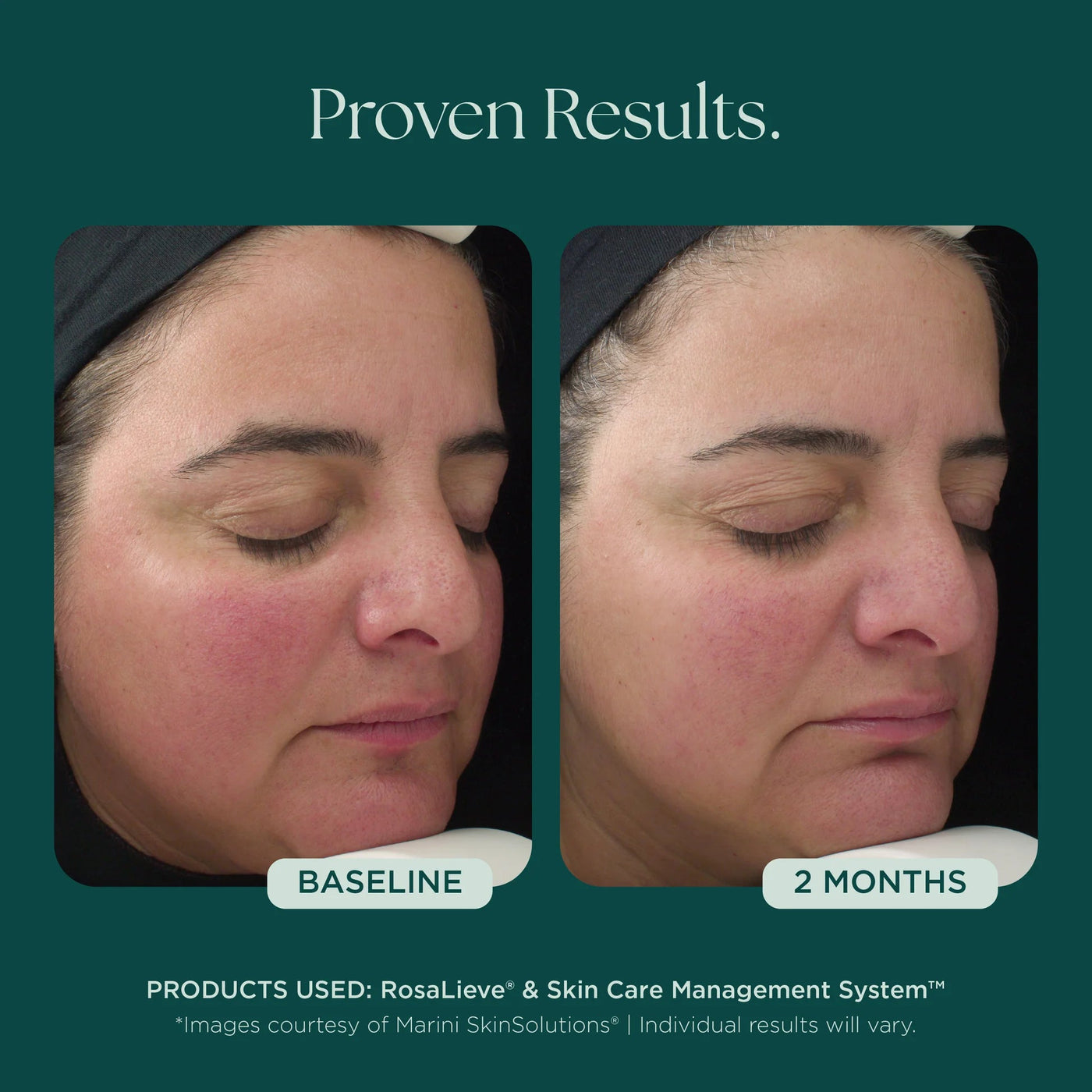 Marini RosaLieve® Redness Reducing Complex - Premium Jan Marini Skin Research from Mysa Day Spa - Just $112! Shop now at Mysa Day Spa