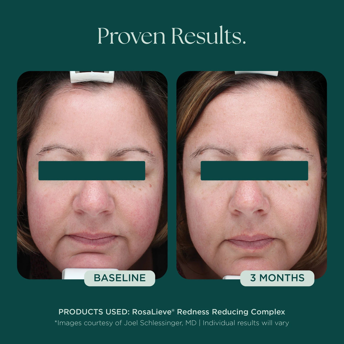 Marini RosaLieve® Redness Reducing Complex - Premium Jan Marini Skin Research from Mysa Day Spa - Just $112! Shop now at Mysa Day Spa