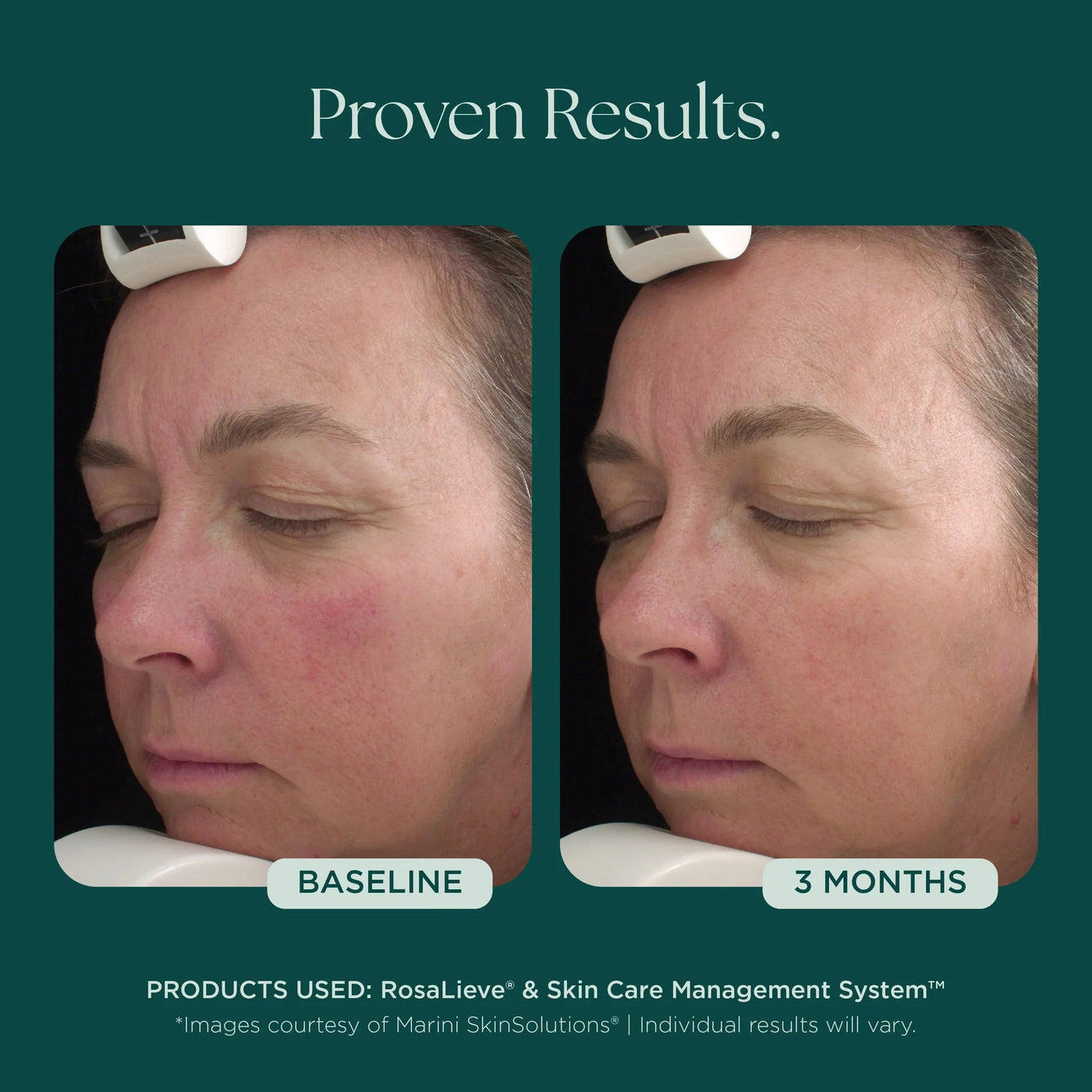 Marini RosaLieve® Redness Reducing Complex - Premium Jan Marini Skin Research from Mysa Day Spa - Just $112! Shop now at Mysa Day Spa