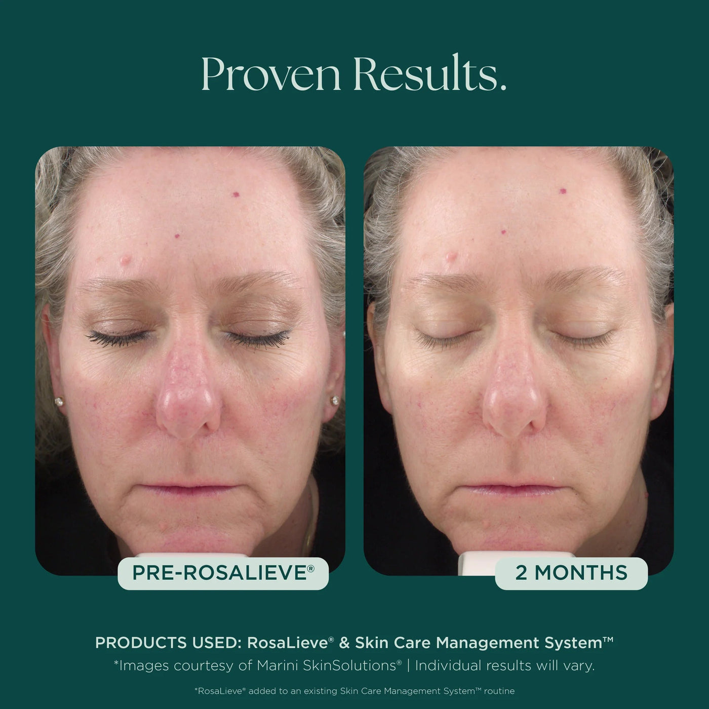 Marini RosaLieve® Redness Reducing Complex - Premium Jan Marini Skin Research from Mysa Day Spa - Just $112! Shop now at Mysa Day Spa