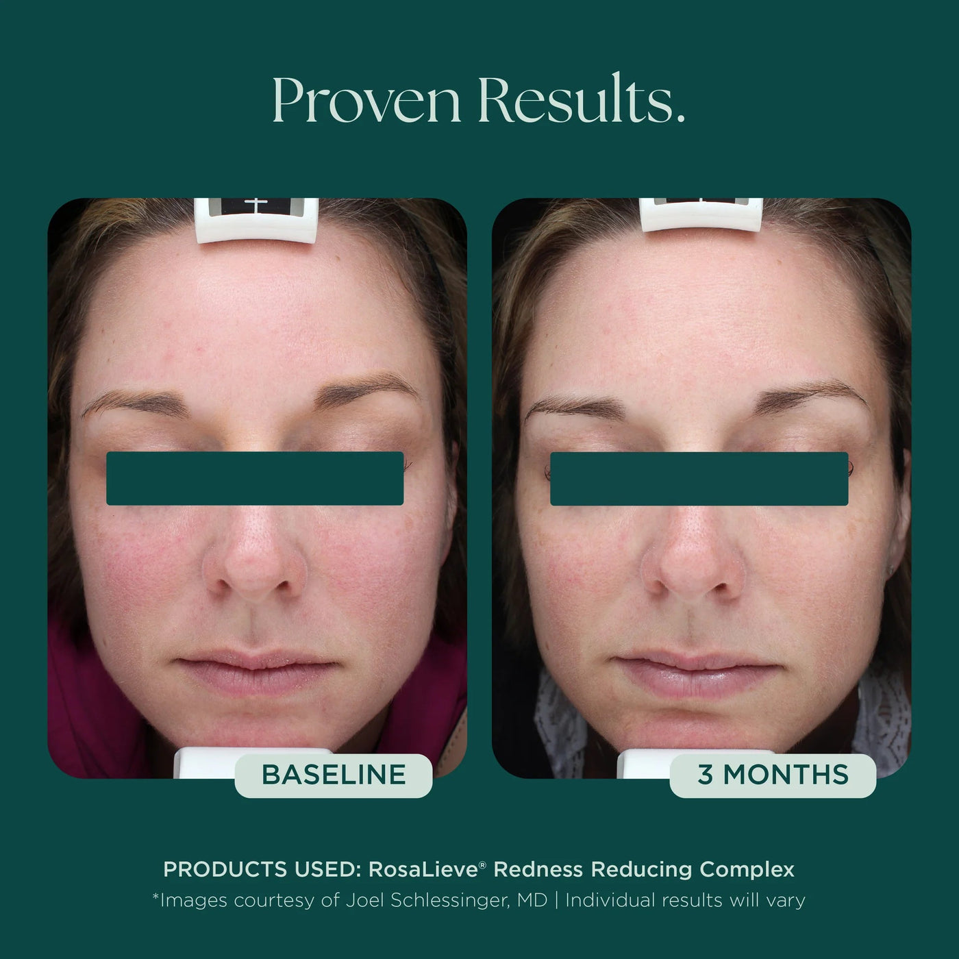 Marini RosaLieve® Redness Reducing Complex - Premium Jan Marini Skin Research from Mysa Day Spa - Just $112! Shop now at Mysa Day Spa
