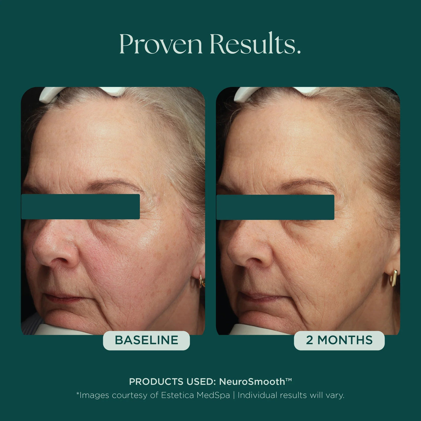 Marini NeuroSmooth® - Premium  from Mysa Day Spa - Just $198! Shop now at Mysa Day Spa