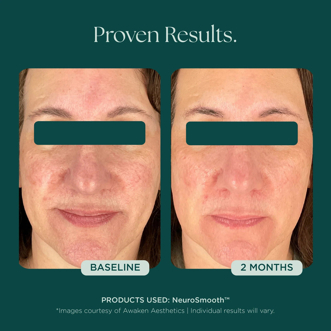 Marini NeuroSmooth® - Premium  from Mysa Day Spa - Just $198! Shop now at Mysa Day Spa