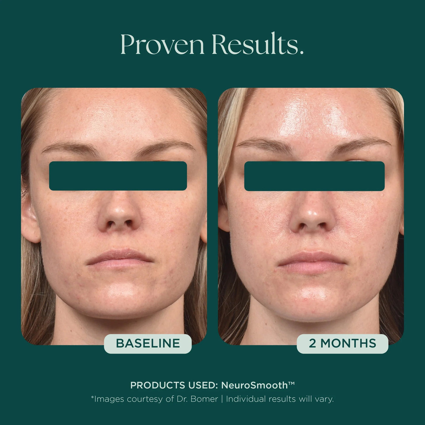Marini NeuroSmooth® - Premium  from Mysa Day Spa - Just $198! Shop now at Mysa Day Spa