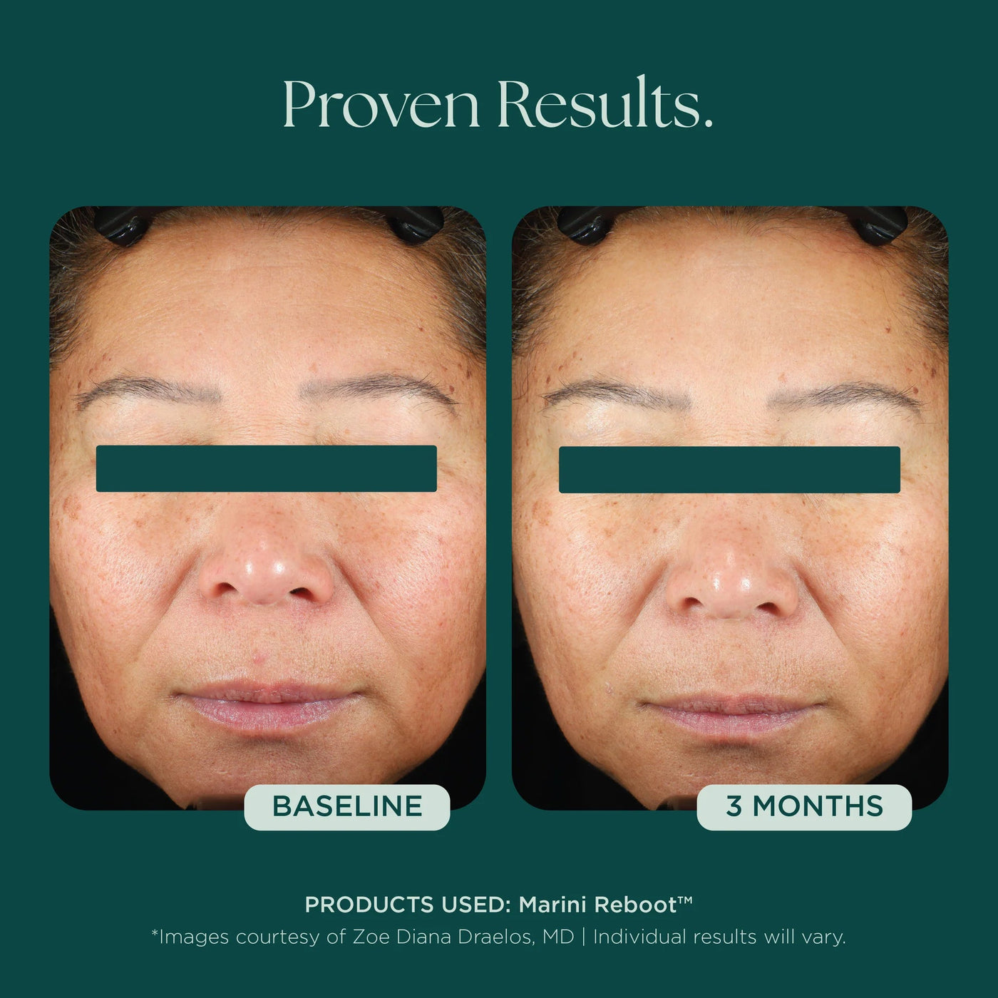 Marini Reboot™ PDRN Face Serum - Premium Jan Marini Skin Research from Mysa Day Spa - Just $160! Shop now at Mysa Day Spa