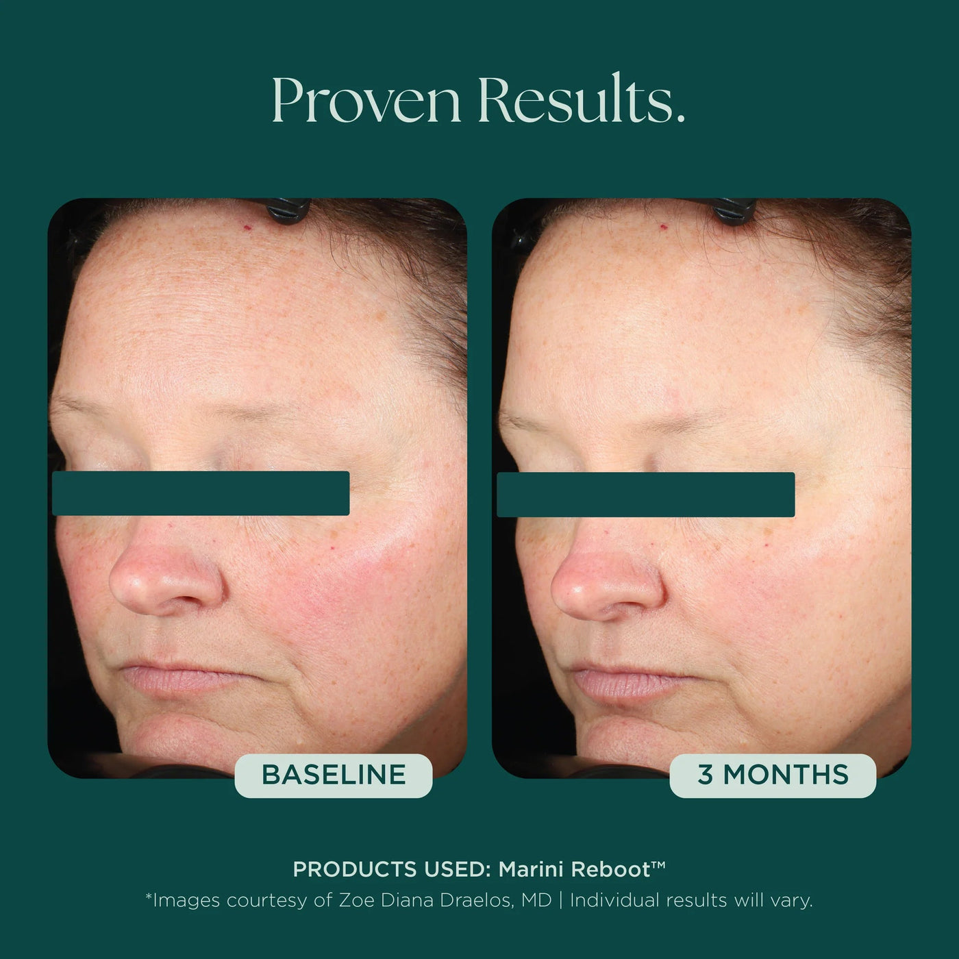 Marini Reboot™ PDRN Face Serum - Premium Jan Marini Skin Research from Mysa Day Spa - Just $160! Shop now at Mysa Day Spa