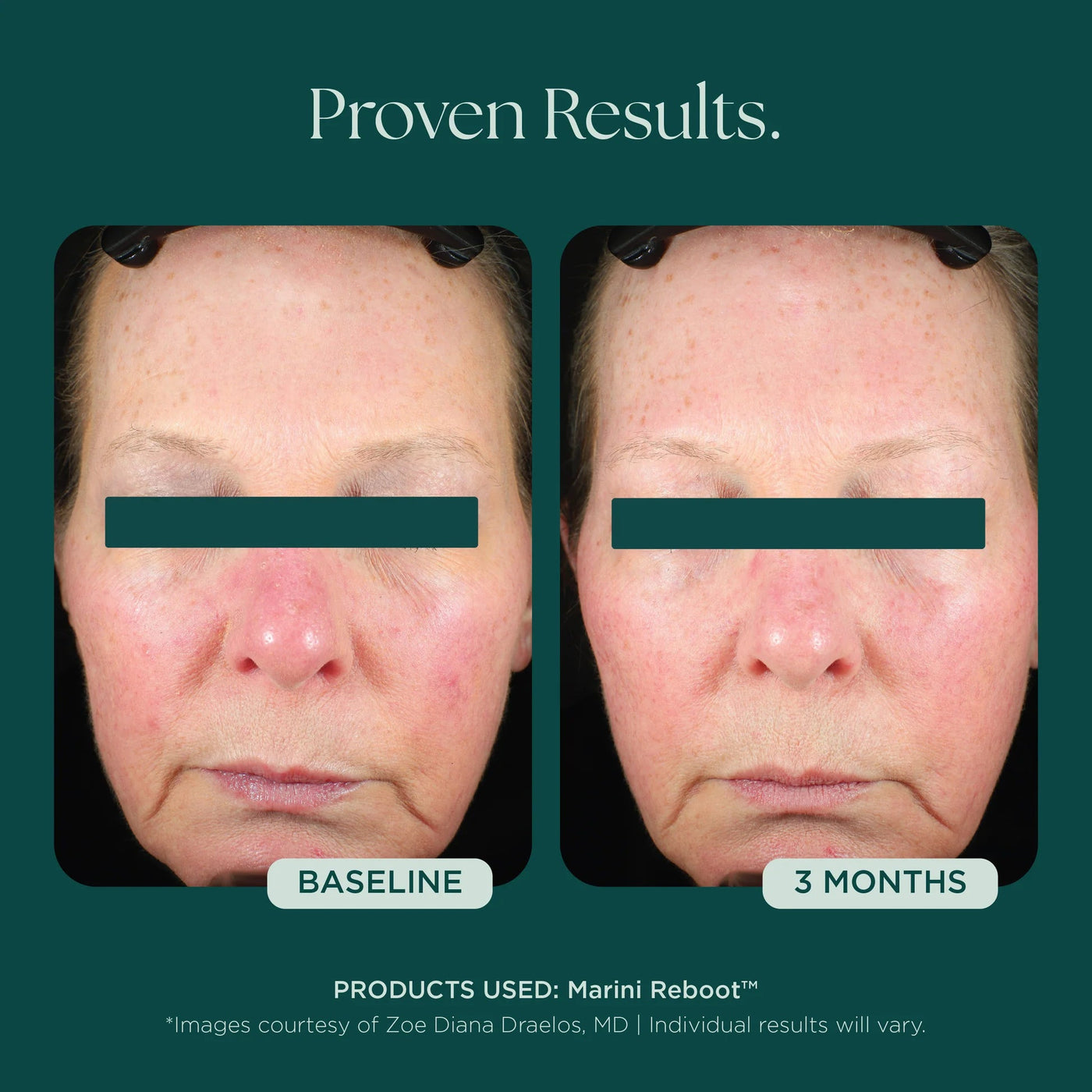 Marini Reboot™ PDRN Face Serum - Premium Jan Marini Skin Research from Mysa Day Spa - Just $160! Shop now at Mysa Day Spa